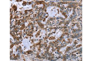 Immunohistochemistry of Human liver cancer using IMPDH2 Polyclonal Antibody at dilution of 1:60 (IMPDH2 抗体)