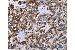 Immunohistochemistry of Human liver cancer using IMPDH2 Polyclonal Antibody at dilution of 1:60