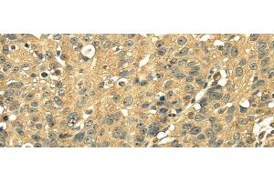 Immunohistochemistry of paraffin-embedded Human breast cancer using RPS3 Polyclonal Antibody at dilution of 1/25 (RPS3 抗体)