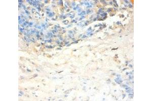 Immunohistochemistry of paraffin-embedded human ovarian cancer using ABIN7144333 at dilution of 1:100 (SLPI 抗体  (AA 26-132))