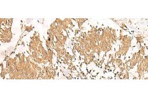 Immunohistochemistry of paraffin-embedded Human lung cancer tissue using MTHFD2L Polyclonal Antibody at dilution of 1:30(x200) (MTHFD2L 抗体)