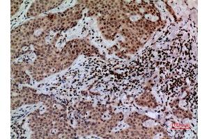 Immunohistochemistry (IHC) analysis of paraffin-embedded Human Mammary Cancer, antibody was diluted at 1:100. (CACYBP 抗体  (C-Term))