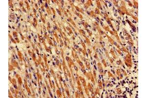 Immunohistochemistry of paraffin-embedded human liver cancer using ABIN7149048 at dilution of 1:100 (CRIPT 抗体  (AA 1-101))