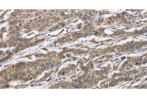 Immunohistochemistry of paraffin-embedded Human gastic cancer using IPO7 Polyclonal Antibody at dilution of 1:40 (IPO7 抗体)