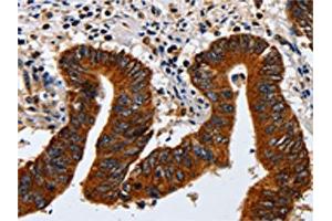 The image on the left is immunohistochemistry of paraffin-embedded Human colon cancer tissue using ABIN7130042(KRT23 Antibody) at dilution 1/20, on the right is treated with fusion protein. (KRT23 抗体)