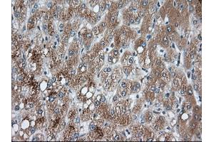 Immunohistochemical staining of paraffin-embedded Carcinoma of Human prostate tissue using anti-PANK2 mouse monoclonal antibody. (PANK2 抗体)