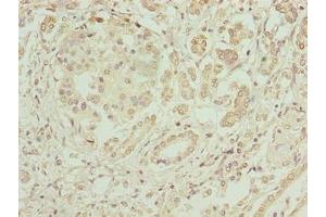 Immunohistochemistry of paraffin-embedded human pancreatic cancer using ABIN7152004 at dilution of 1:100 (ERO1LB 抗体  (AA 101-400))