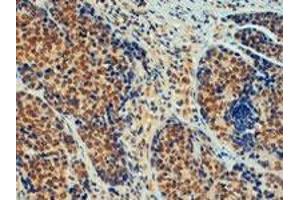 TRIM24 polyclonal antibody  (4 ug/mL) staining of paraffin embedded human breast cancer. (TRIM24 抗体  (C-Term))