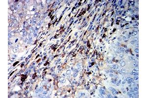 Immunohistochemical analysis of paraffin-embedded cervical cancer tissues using CD45R mouse mAb with DAB staining. (CD45 抗体  (AA 378-577))