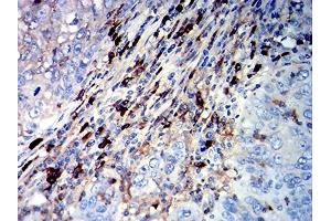 Immunohistochemical analysis of paraffin-embedded cervical cancer tissues using CD45R mouse mAb with DAB staining. (CD45 抗体  (AA 378-577))