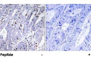 Immunohistochemical analysis of paraffin-embedded human colon carcinoma tissue using MEF2D polyclonal antibody . (MEF2D 抗体)