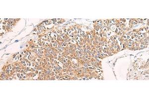 Immunohistochemistry of paraffin-embedded Human prost at e cancer tissue using C14orf2 Polyclonal Antibody at dilution of 1:60(x200) (C14orf2 抗体)