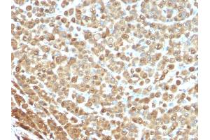 Formalin-fixed, paraffin-embedded human Melanoma stained with S100A1 Mouse Monoclonal Antibody (S1/61)