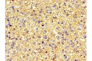 Immunohistochemistry of paraffin-embedded human glioma using ABIN7146632 at dilution of 1:100