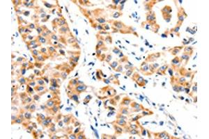 The image on the left is immunohistochemistry of paraffin-embedded Human lung cancer tissue using ABIN7191765(PAFAH1B1 Antibody) at dilution 1/25, on the right is treated with synthetic peptide. (PAFAH1B1 抗体)