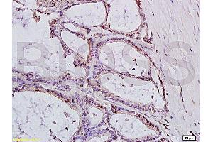 Formalin-fixed and paraffin embedded: human colon carcinoma labeled with Anti-MTLC Polyclonal Antibody (ABIN728015), Unconjugated at 1:200, followed by conjugation to the secondary antibody and DAB staining (Myc Target 1 抗体  (AA 21-100))