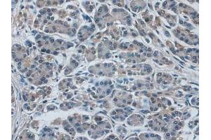 IHC-P analysis of Human Pancreas Cancer Tissue, with DAB staining. (IDE 抗体  (AA 753-973))