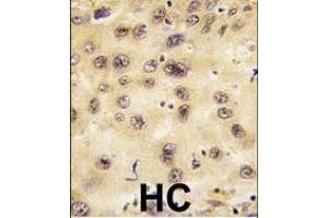 Formalin-fixed and paraffin-embedded human hepatocarcinoma tissue reacted with PROX1 antibody (Center), which was peroxidase-conjugated to the secondary antibody, followed by DAB staining. (PROX1 抗体  (AA 185-214))