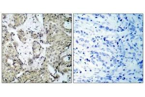 Immunohistochemical analysis of paraffin- embedded human breast carcinoma tissue, using MKK3 (phospho-Ser189) antibody (E011145). (MAP2K3 抗体  (pSer189))