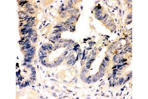 IHC-P: Caspase-7 antibody testing of human intestinal cancer tissue (Caspase 7 抗体  (AA 237-255))