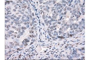 Immunohistochemical staining of paraffin-embedded Adenocarcinoma of colon tissue using anti-PPP5Cmouse monoclonal antibody. (PP5 抗体)