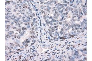 Immunohistochemical staining of paraffin-embedded Adenocarcinoma of colon tissue using anti-PPP5Cmouse monoclonal antibody. (PP5 抗体)