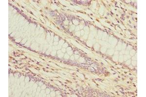 Immunohistochemistry of paraffin-embedded human colon cancer using ABIN7158367 at dilution of 1:100 (LMO4 抗体  (AA 1-165))