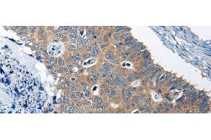 Immunohistochemistry of paraffin-embedded Human colorectal cancer tissue using RTN4IP1 Polyclonal Antibody at dilution of 1:50(x200) (RTN4IP1 抗体)