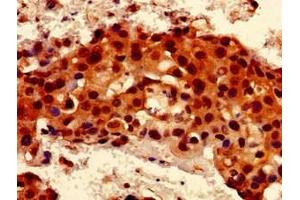 Immunohistochemistry of paraffin-embedded human breast cancer using ABIN7167078 at dilution of 1:100 (RALBP1 抗体  (AA 6-105))