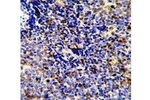 IHC analysis of FFPE human lymphoma stained with MERTK antibody (MERTK 抗体)