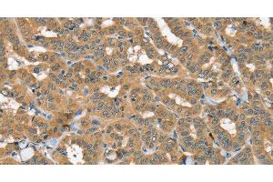 Immunohistochemistry of paraffin-embedded Human thyroid cancer using SEC14L2 Polyclonal Antibody at dilution of 1:40 (SEC14L2 抗体)