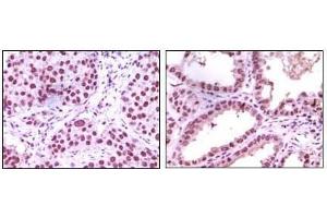Immunohistochemical analysis of paraffin-embedded human lung carcinoma (left) and kidney carcinoma (right), showing nuclear localization using LSD1 antibody with DAB staining. (LSD1 抗体)