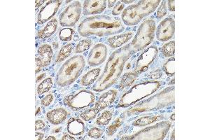 Immunohistochemistry of paraffin-embedded human liver cancer using GAPDH Mouse mAb (ABIN3020540, ABIN3020541, ABIN3020542 and ABIN1512934) at dilution of 1:100 (40x lens). (GAPDH 抗体)