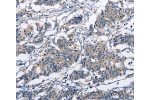 Immunohistochemistry of Human gastric cancer using CAPZA2 Polyclonal Antibody at dilution of 1:30 (CAPZA2 抗体)