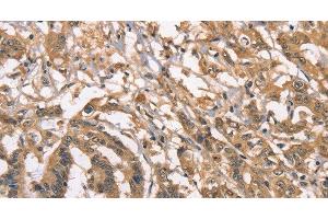 Immunohistochemistry of paraffin-embedded Human colon cancer using PEBP1 Polyclonal Antibody at dilution of 1:40 (PEBP1 抗体)