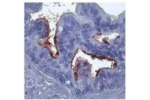 MMP1 in epithelial cells ovarian carcinoma was detected using HRP/DAB brown color stain. (MMP1 抗体)