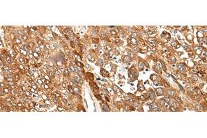 Immunohistochemistry of paraffin-embedded Human liver cancer tissue using CAD Polyclonal Antibody at dilution of 1:50(x200) (CAD 抗体)