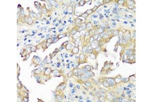 Immunohistochemistry of paraffin-embedded Human lung cancer using EIF3B Polyclonal Antibody at dilution of 1:100 (40x lens). (EIF3B 抗体)