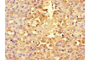 Immunohistochemistry of paraffin-embedded human breast cancer using ABIN7142567 at dilution of 1:100 (RPS6 抗体  (AA 35-229))