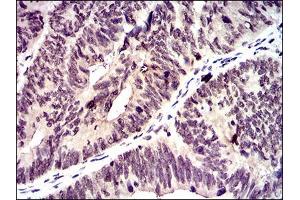 Immunohistochemical analysis of paraffin-embedded rectum cancer tissues using ID2 mouse mAb with DAB staining. (Id2 抗体  (AA 1-134))