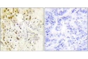 Immunohistochemistry analysis of paraffin-embedded human breast carcinoma tissue, using Cyclin L1 Antibody. (Cyclin L1 抗体  (AA 461-510))