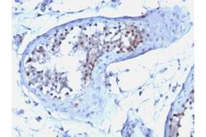 Immunohistochemical staining (Formalin-fixed paraffin-embedded sections) of human testicular carcinoma with CCNB1 monoclonal antibody, clone CCNB1/1098 .