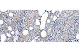 Immunohistochemistry of paraffin-embedded Human thyroid cancer tissue using FKBPL Polyclonal Antibody at dilution of 1:50(x200) (FKBPL 抗体)