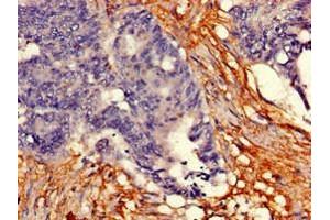 Immunohistochemistry of paraffin-embedded human colon cancer using ABIN7173617 at dilution of 1:100