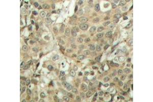 Immunohistochemistry of paraffin-embedded Human breast carcinoma tissue, using Phospho-CFL1(S3) Polyclonal Antibody (Cofilin 抗体  (pSer3))