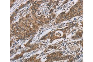 Immunohistochemistry of Human gastric cancer using AGER Polyclonal Antibody at dilution of 1:70 (RAGE 抗体)