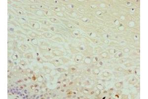 Immunohistochemistry of paraffin-embedded human cervical cancer using ABIN7149983 at dilution of 1:100 (DPP3 抗体  (AA 1-280))
