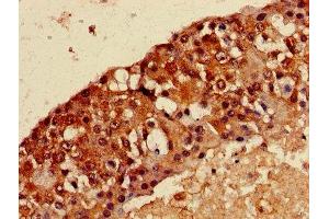 Immunohistochemistry of paraffin-embedded human breast cancer using ABIN7159273 at dilution of 1:100 (MAGEA8 抗体  (AA 1-270))