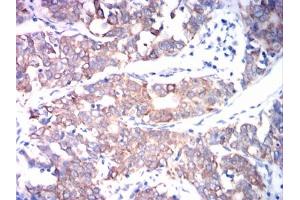 Immunohistochemical analysis of paraffin-embedded cervical cancer tissues using ADAM10 mouse mAb with DAB staining. (ADAM10 抗体)