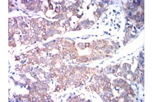 Immunohistochemical analysis of paraffin-embedded cervical cancer tissues using ADAM10 mouse mAb with DAB staining.